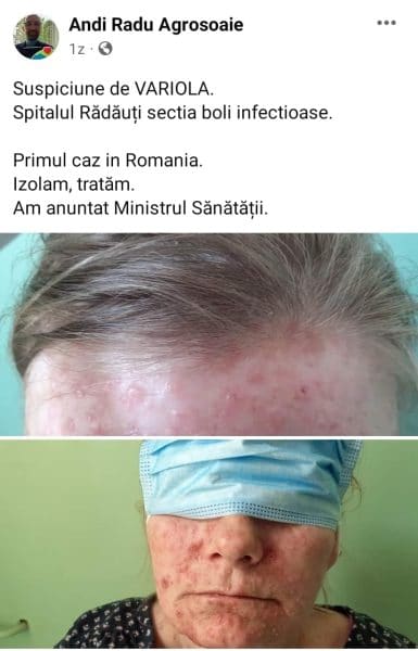 ANCHETĂ la Spitalul din Rădăuți, SUCEAVA! Un medic a lansat o ALARMA FALSĂ privind descoperirea PRIMULUI caz de VARIOLĂ - News Moldova